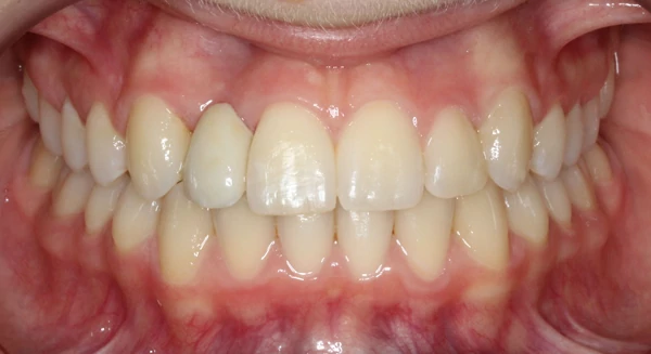 Patient smile after orthodontic treatment