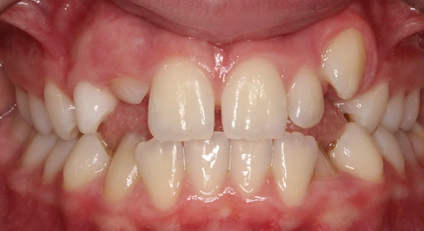 Patient smile before orthodontic treatment